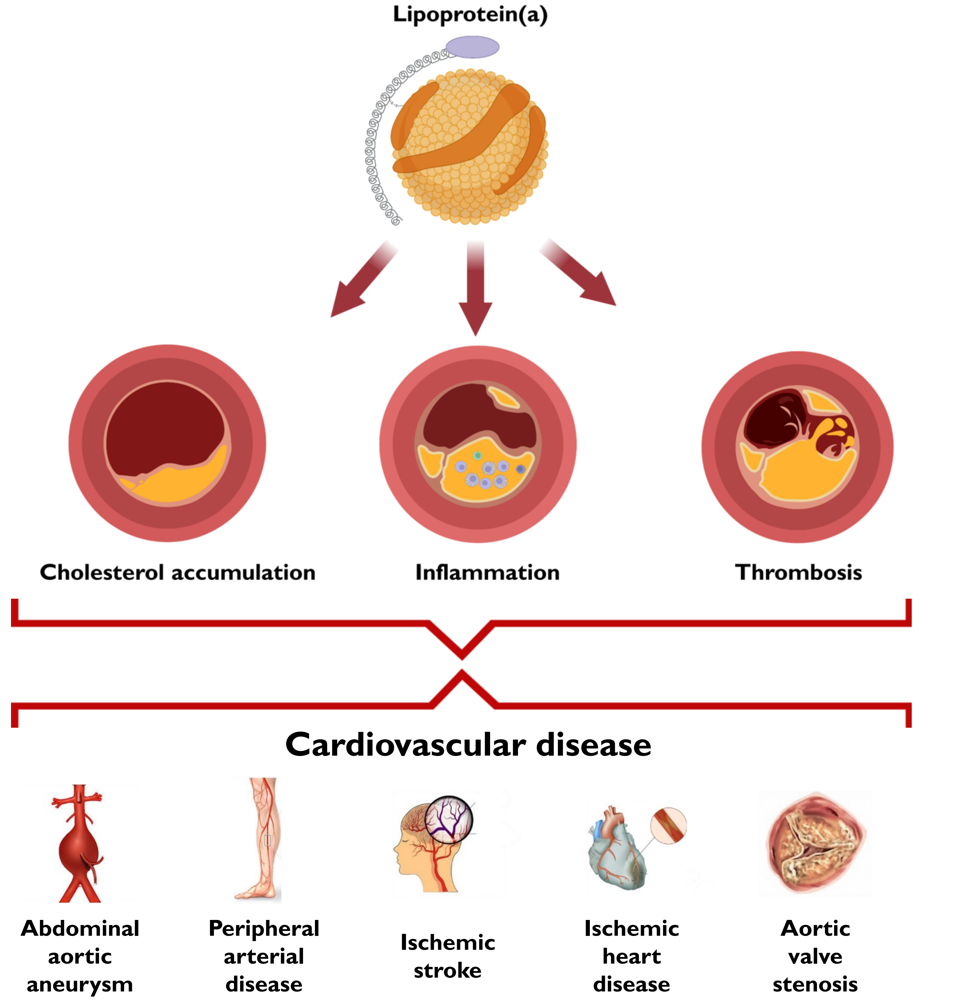 Lipoprotein(a) in cardiovascular disease with focus on peripheral ...